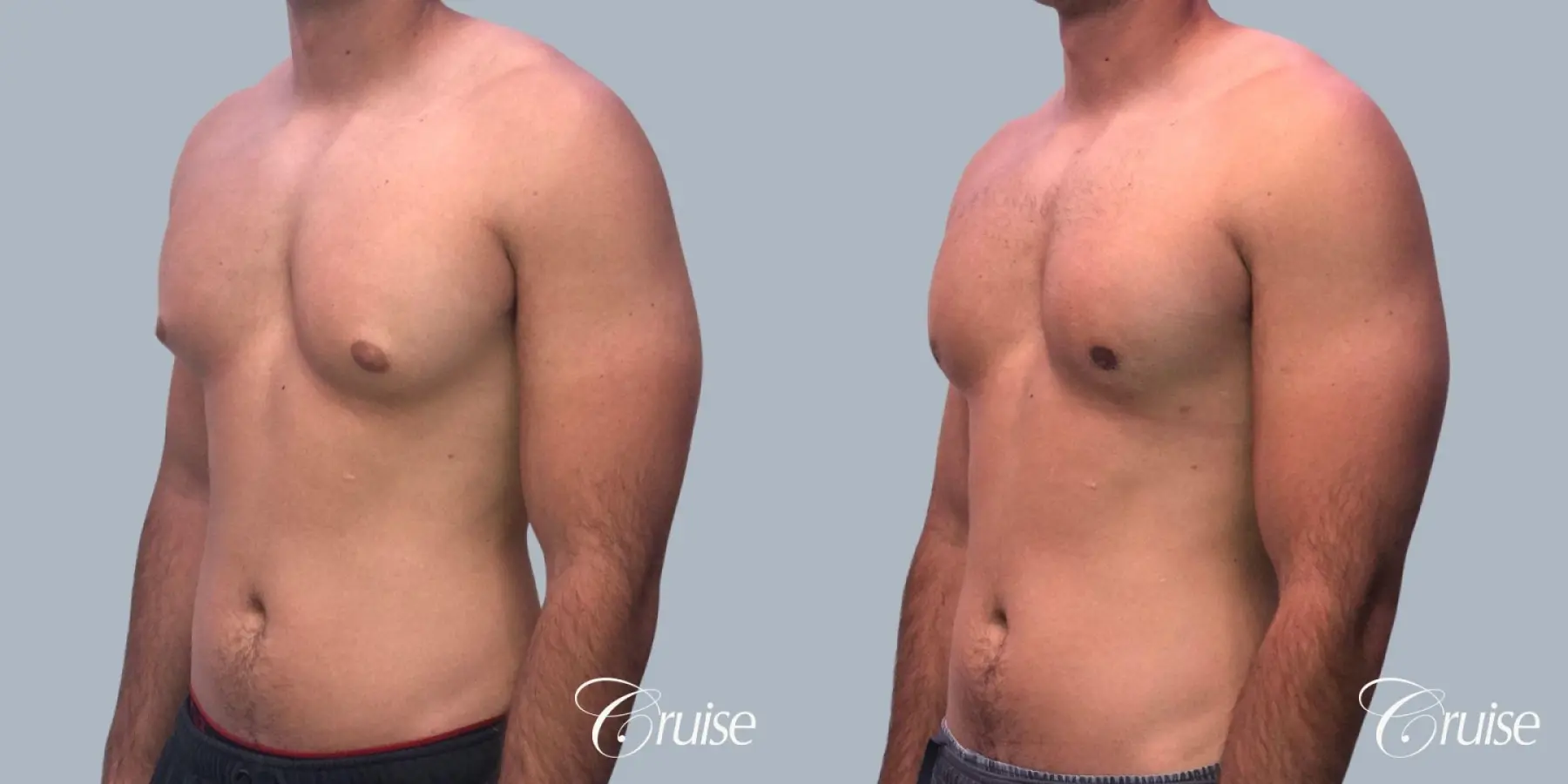 Gynecomastia: Patient 156 - Before and After 3