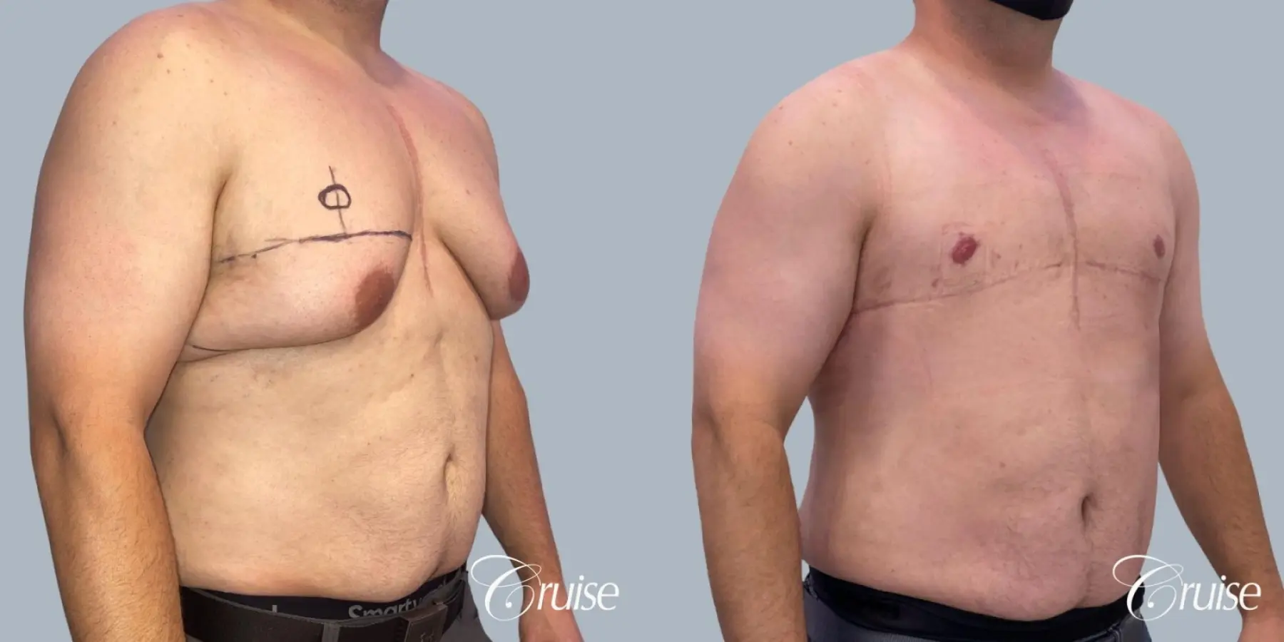 Gynecomastia: Patient 3 - Before and After 2