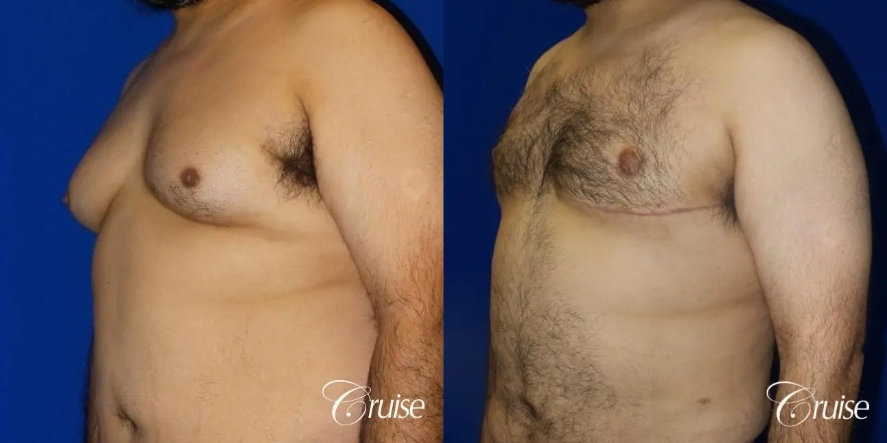 Type 4.5 Gynecomastia Free Nipple Graft - Before and After 2