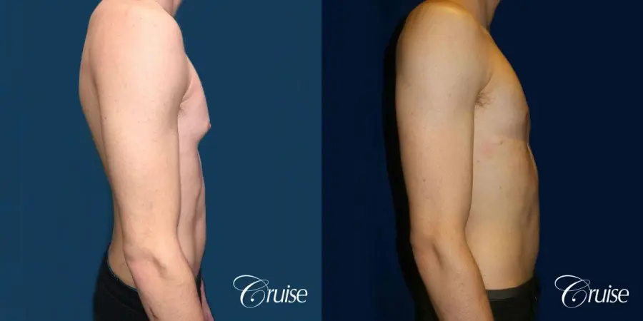 Top Gynecomastia Specialist Dr. Cruise - Before and After 4