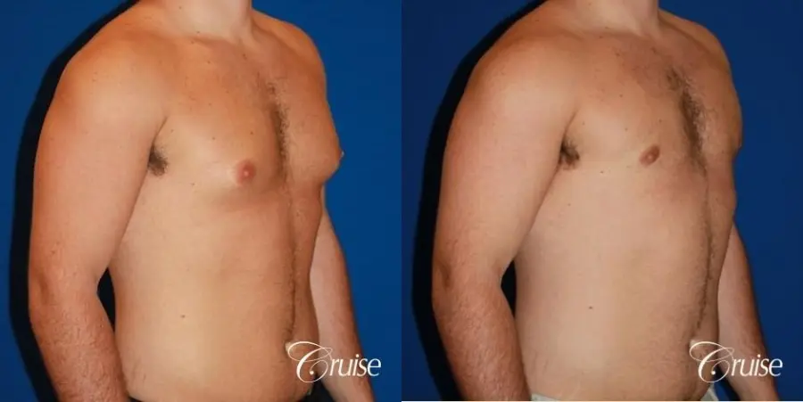 athletic adult with puffy nipple - Before and After 3
