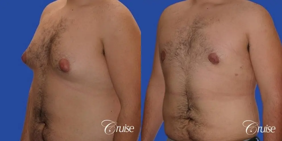 Gynecomastia with pointy nipples - Before and After 2