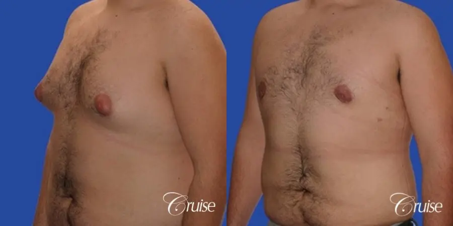 Gynecomastia with pointy nipples - Before and After 2