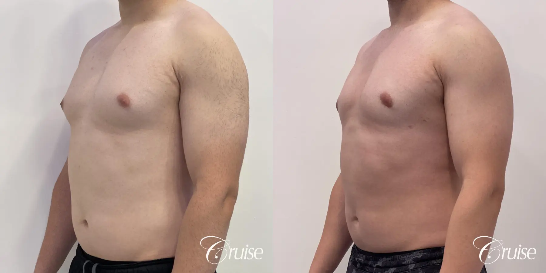 Gynecomastia: Patient 129 - Before and After 2