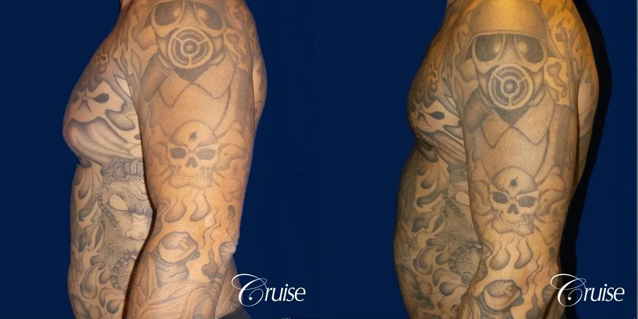 Moderate Gynecomastia Areola Incision - Before and After 2