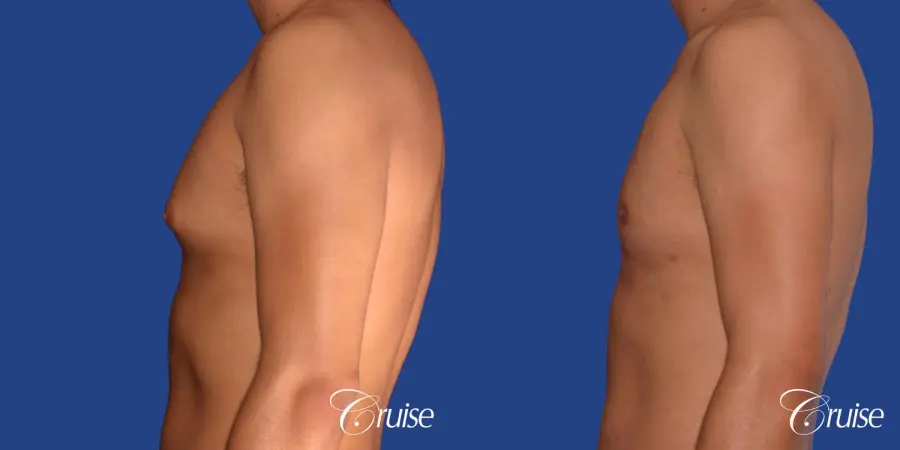 best gynecomastia results with gynecomastia plastic surgeon - Before and After 2