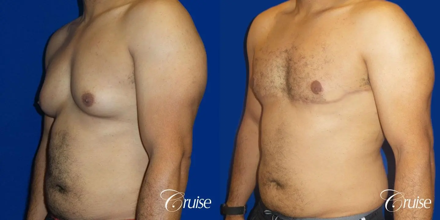 Best gynecomastia specialist in united states - Before and After 2
