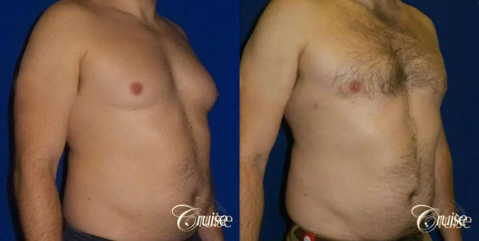 male breast reduction surgery - Before and After 2