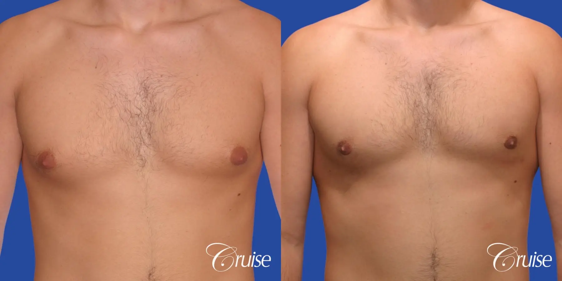 24 yr old body builder mild gynecomastia - Before and After 1