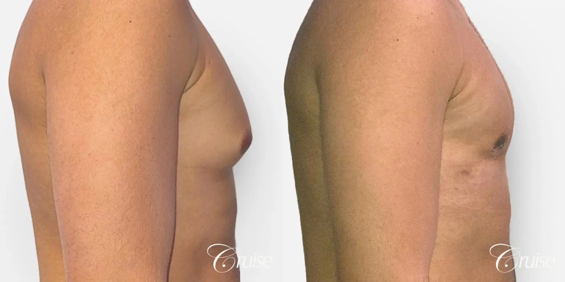 Type 2 Latino Gynecomastia Removal - Before and After 2