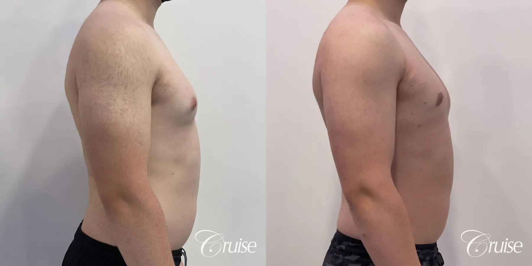 Gynecomastia: Patient 127 - Before and After 5