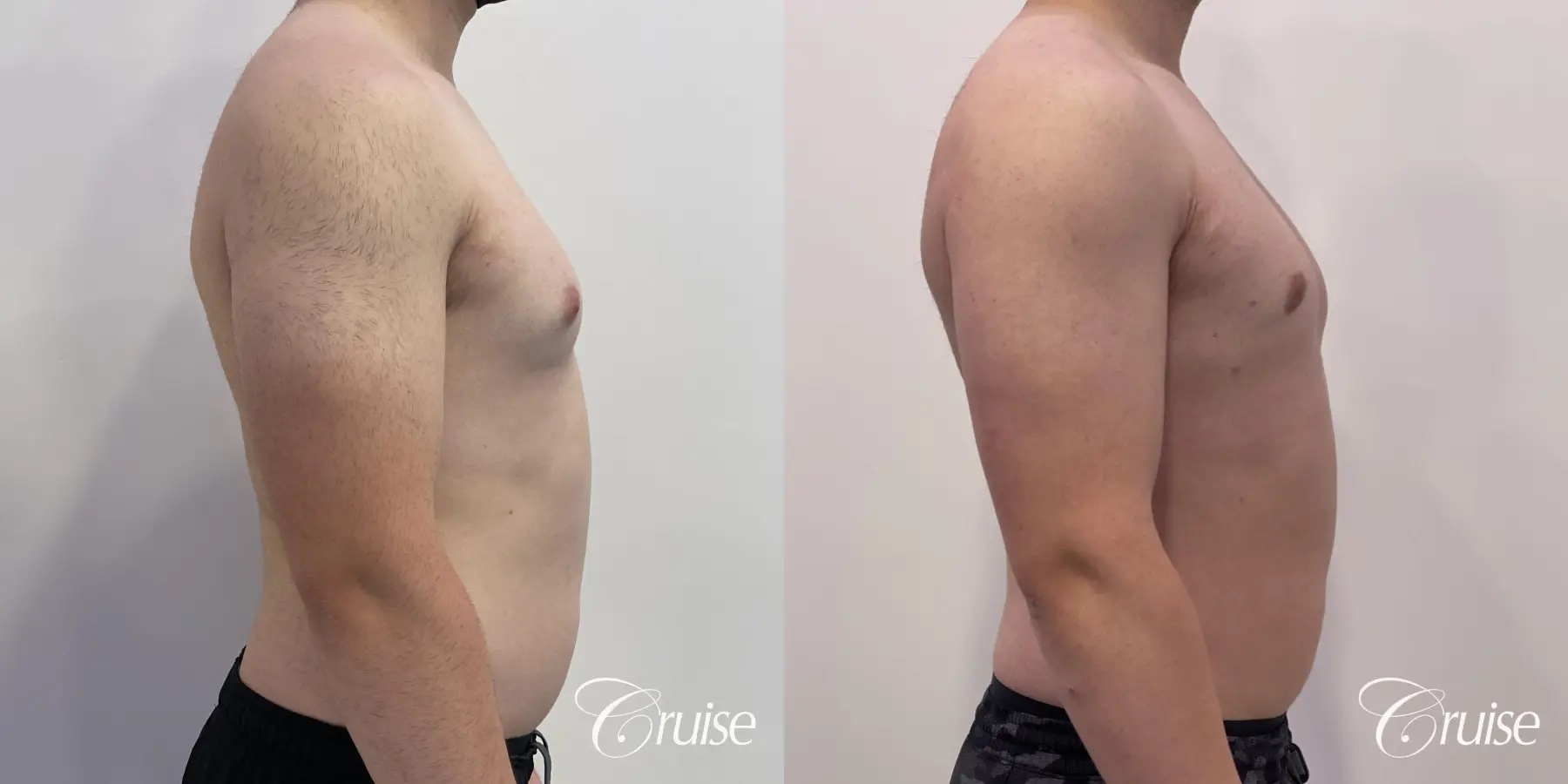 Gynecomastia: Patient 129 - Before and After 5