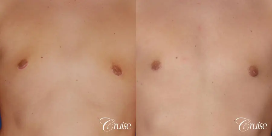 teen with pointy / puffy nipples get gynecomastia surgery - Before and After 4