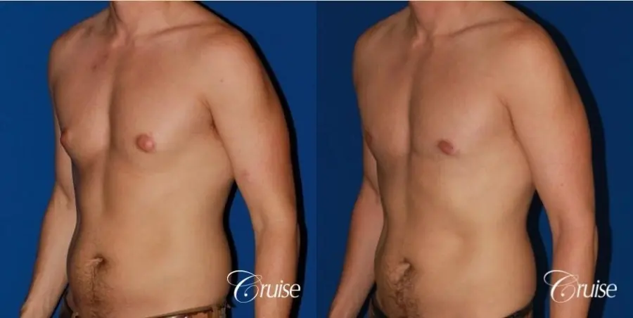 puffy nipple on low body fat - Before and After 3