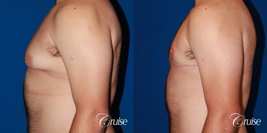 20 with Gynecomastia and puffy nipple - Before and After 2