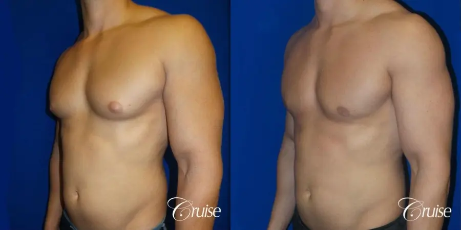 Best before and after gynecomastia pictures - Before and After 2