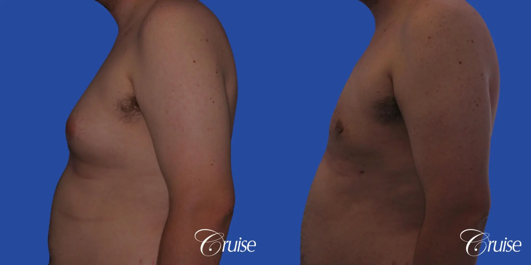 Type 2 Gynecomastia with Excess Breast Tissue - Before and After 2