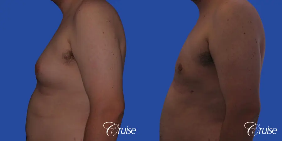 Type 2 Gynecomastia with Excess Breast Tissue - Before and After 2