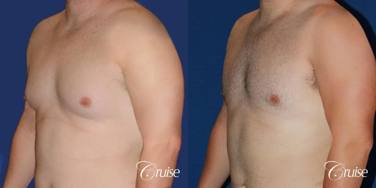 moderate chest gynecomastia and liposuction flanks - Before and After 2