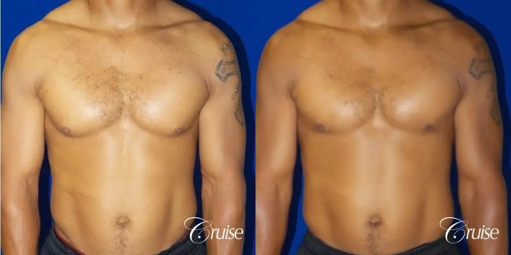 gynecomastia caused by testosterone - Before and After 1
