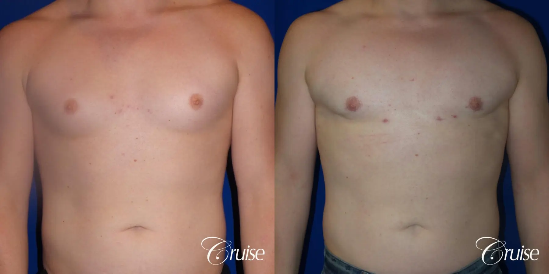 Gynecomastia: Patient 148 - Before and After 1
