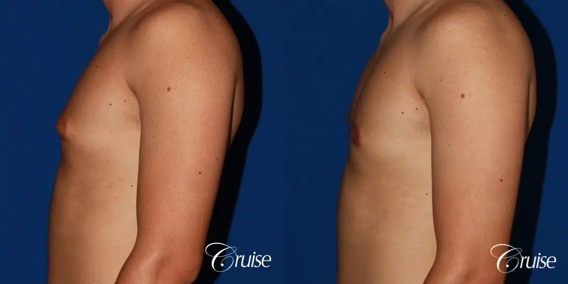 mild gynecomastia before and after with puffy nipple - Before and After 2