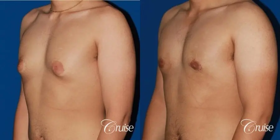 puffy nipple male breast on young adult - Before and After 3