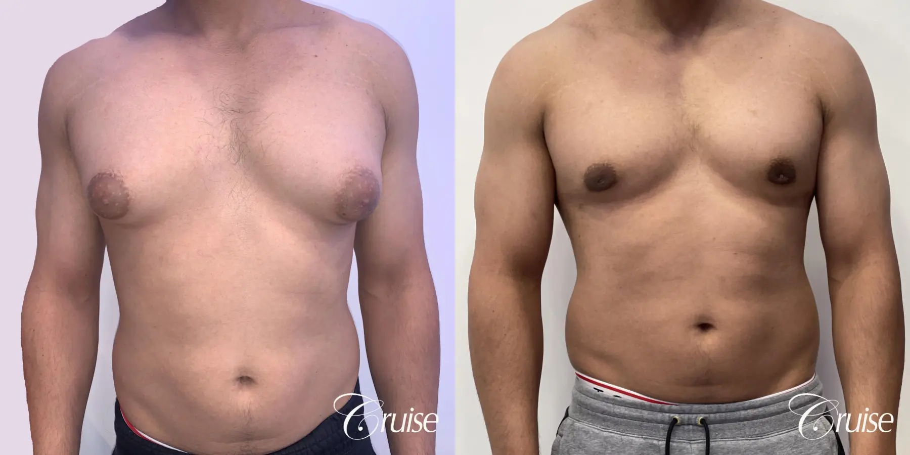 gynecomastia surgery - Before and After 1