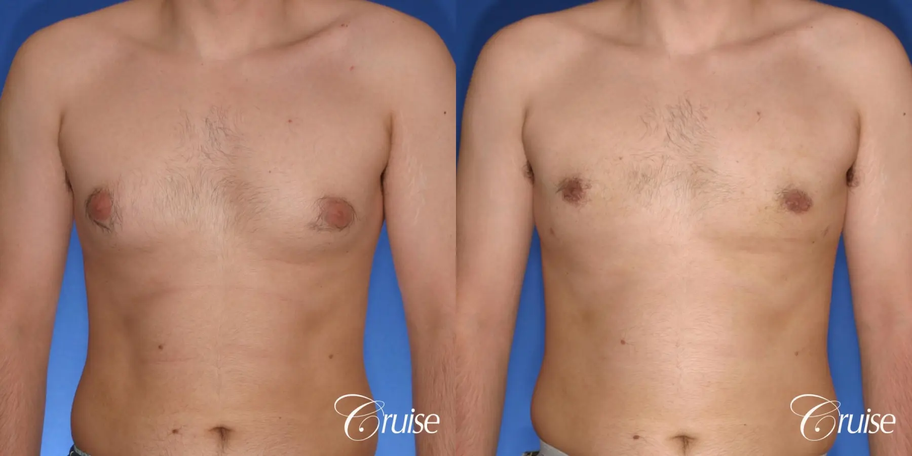 moderate gynecomastia puffy nipple - Before and After 1