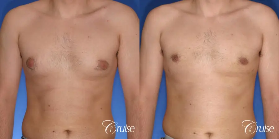 moderate gynecomastia puffy nipple - Before and After 1