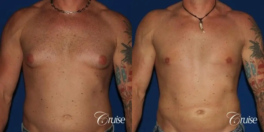 Athletic adult gynecomastia with glandular tissue removal - Before and After 1