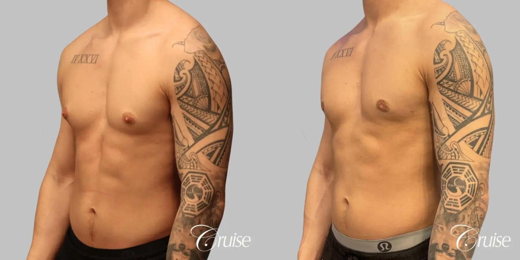 Gynecomastia Type 1 Inferior Crescent - Before and After 4
