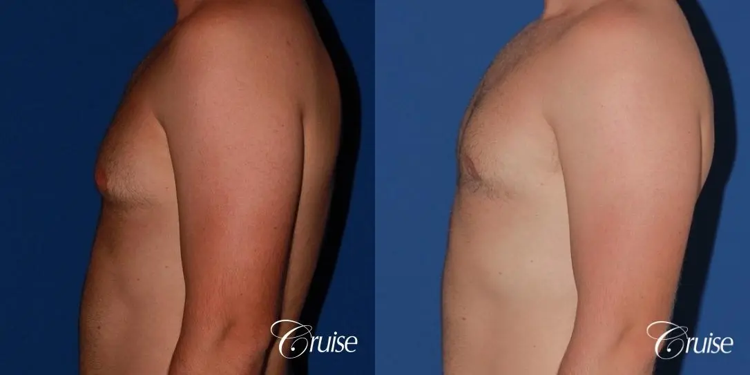 best puffy nipple surgery correction - Before and After 2
