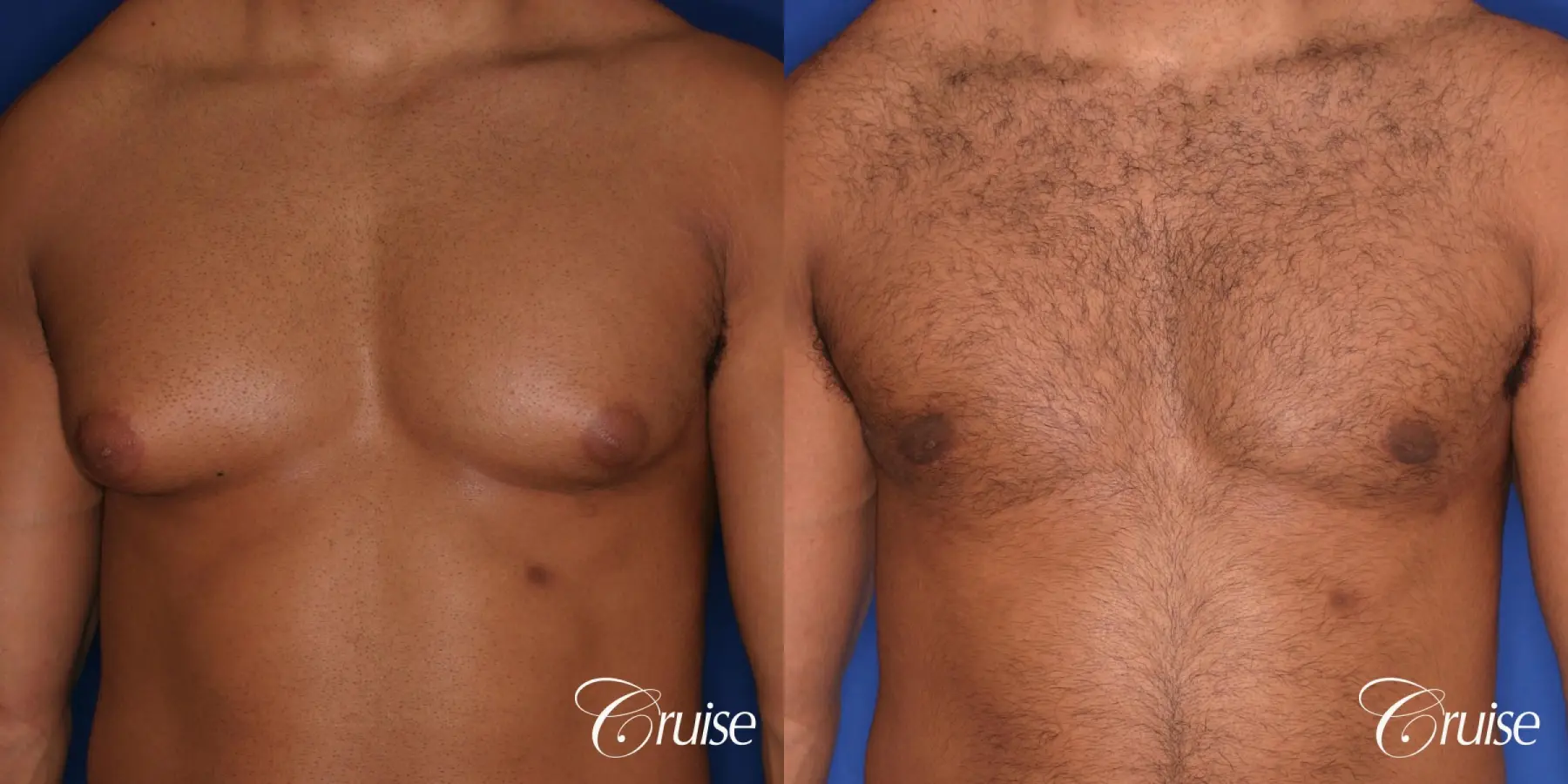 26 yo athletic patient with moderate gynecomastia - Before and After 1