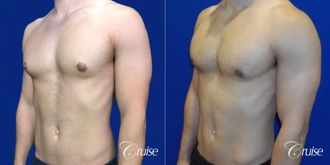 gynecomastia correction newport beach - Before and After 3