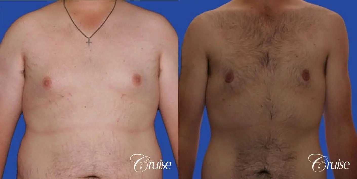 weight loss patient with gynecomastia - Before and After 1