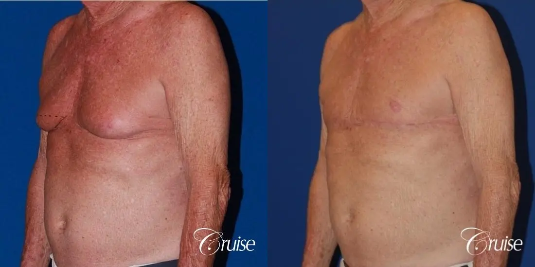 free nipple graft gynecomastia on aging man - Before and After 2