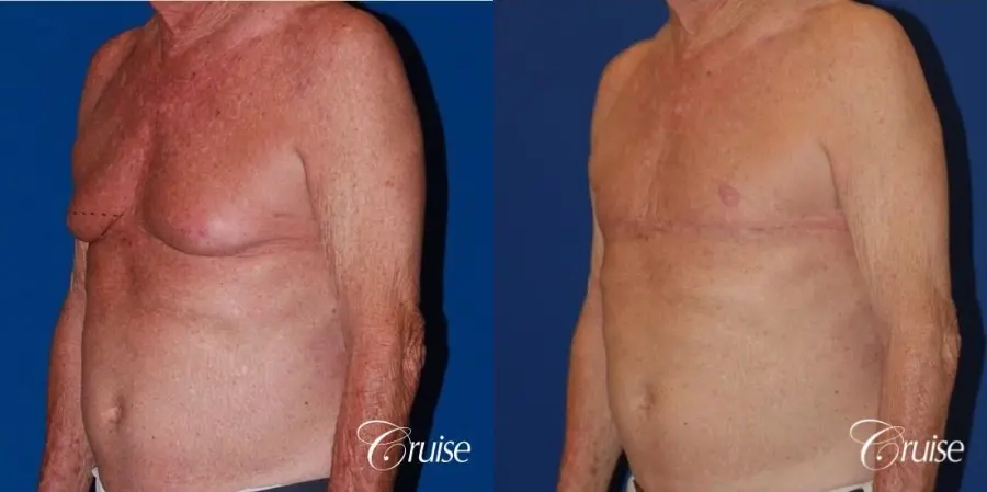 free nipple graft gynecomastia on aging man - Before and After 2
