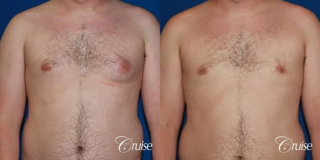 asymmetric gynecomastia moderate - Before and After 1