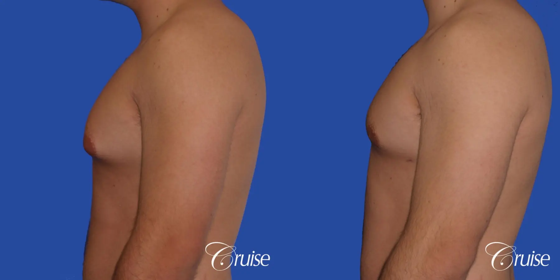 mild case of gynecomastia on adult - Before and After 2