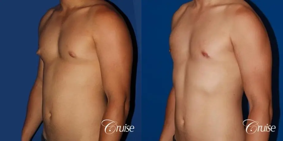 young athletic adult with puffy nipple - Before and After 2