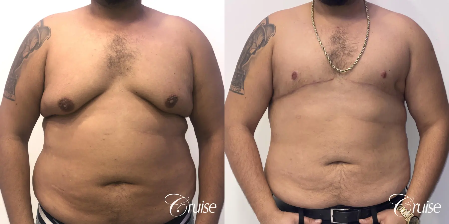 Gynecomastia: Patient 133 - Before and After 1