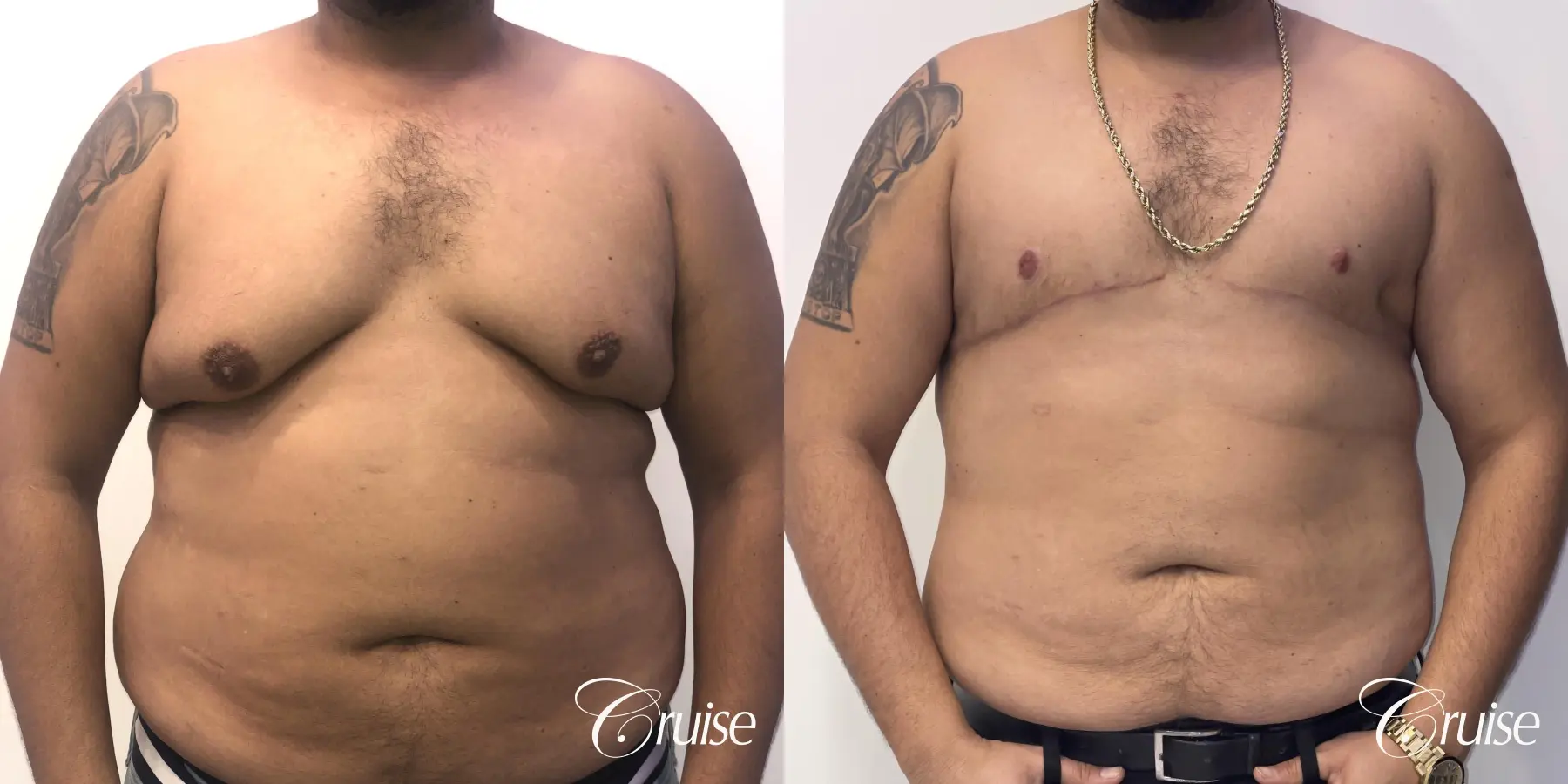 Gynecomastia: Patient 135 - Before and After 1