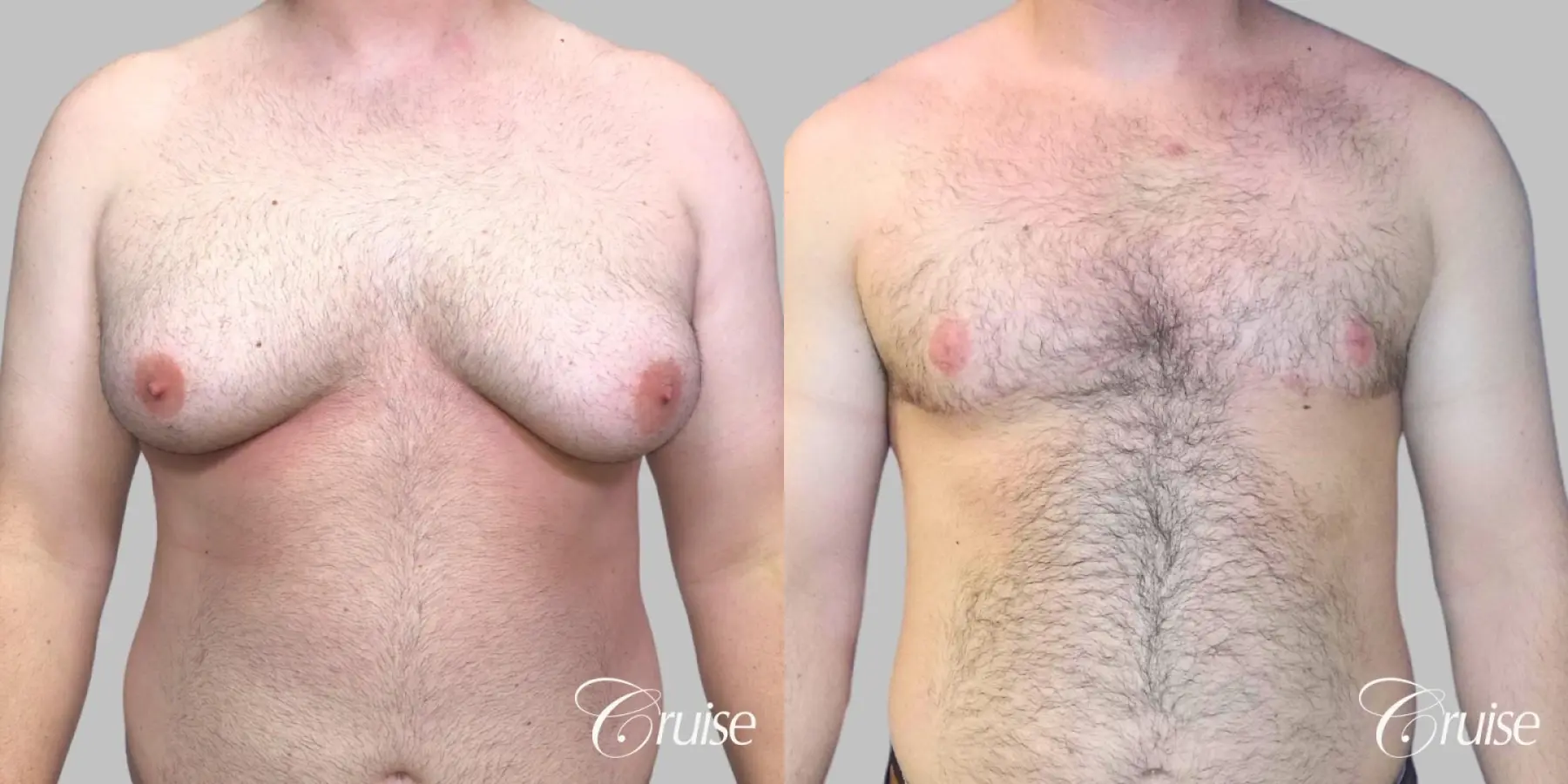 Severe Gynecomastia- Free nipple Graft - Before and After