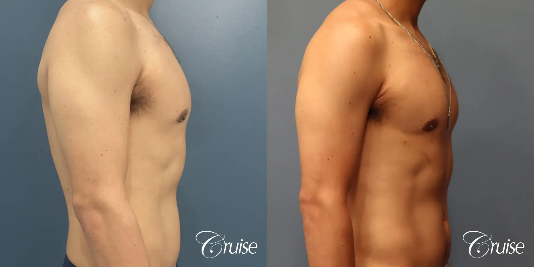 Gynecomastia: Patient 139 - Before and After 3