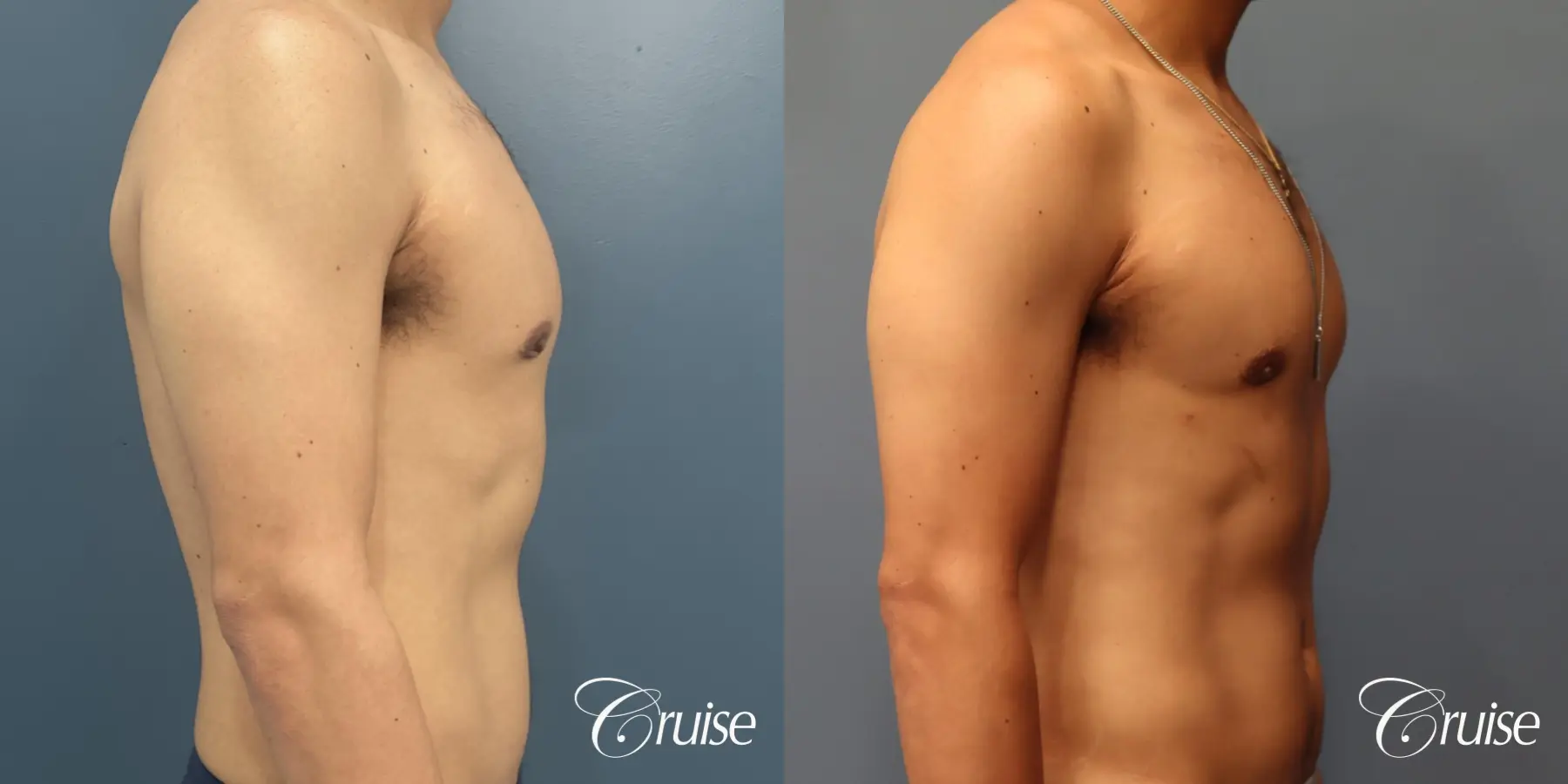 Gynecomastia: Patient 141 - Before and After 3