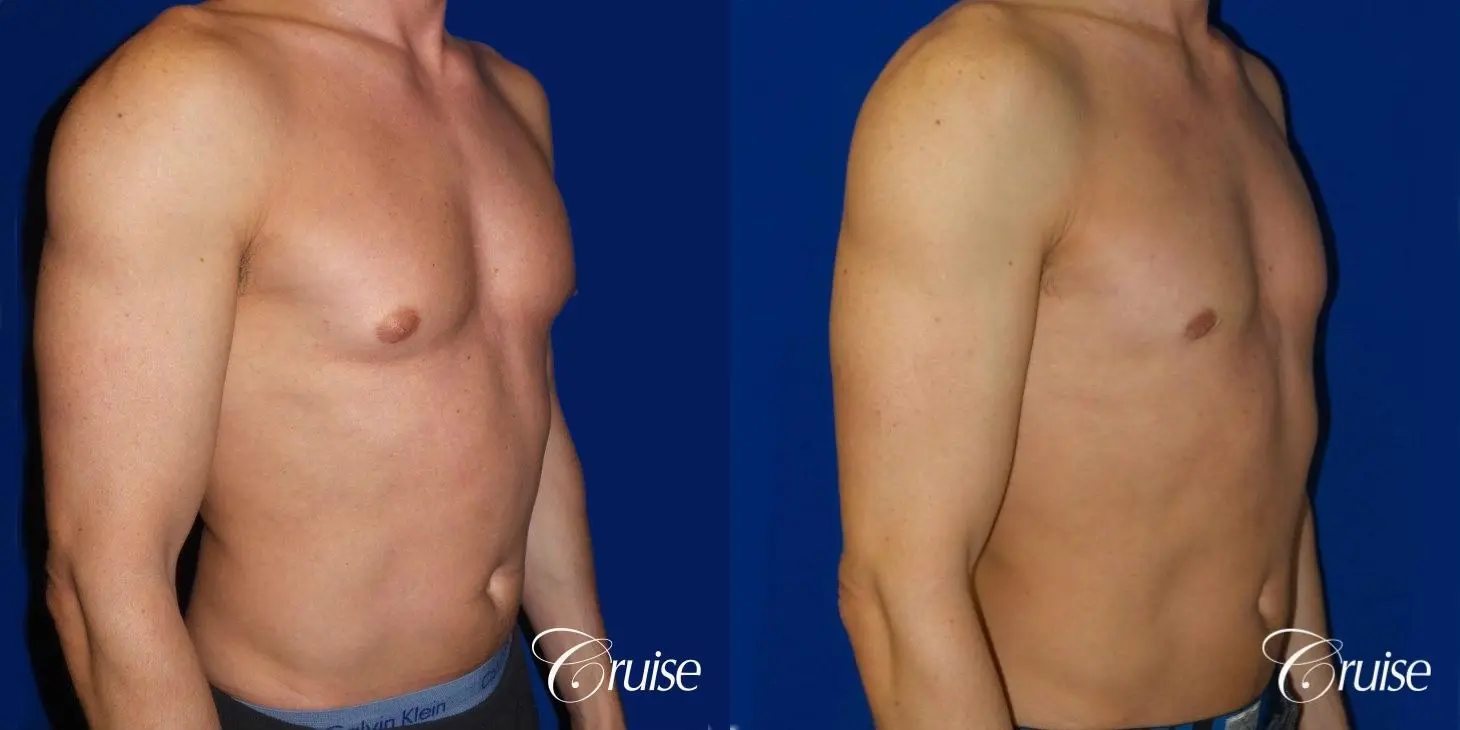 Type 1.5 Puffy Nipple Gynecomastia - Before and After 2