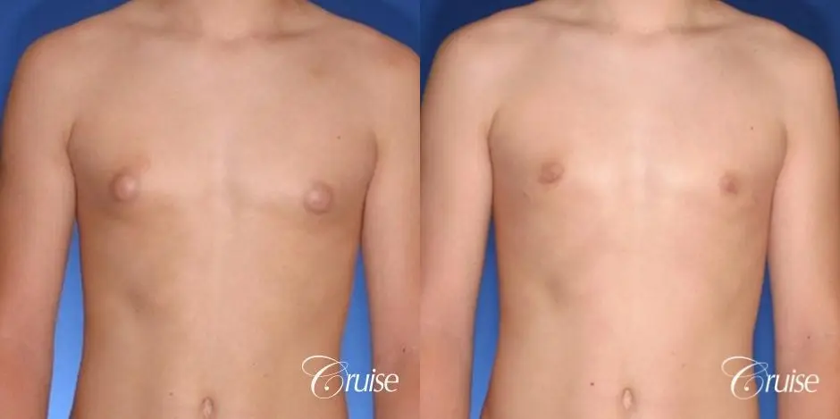 teenage gynecomastia with puffy nipple - Before and After 1