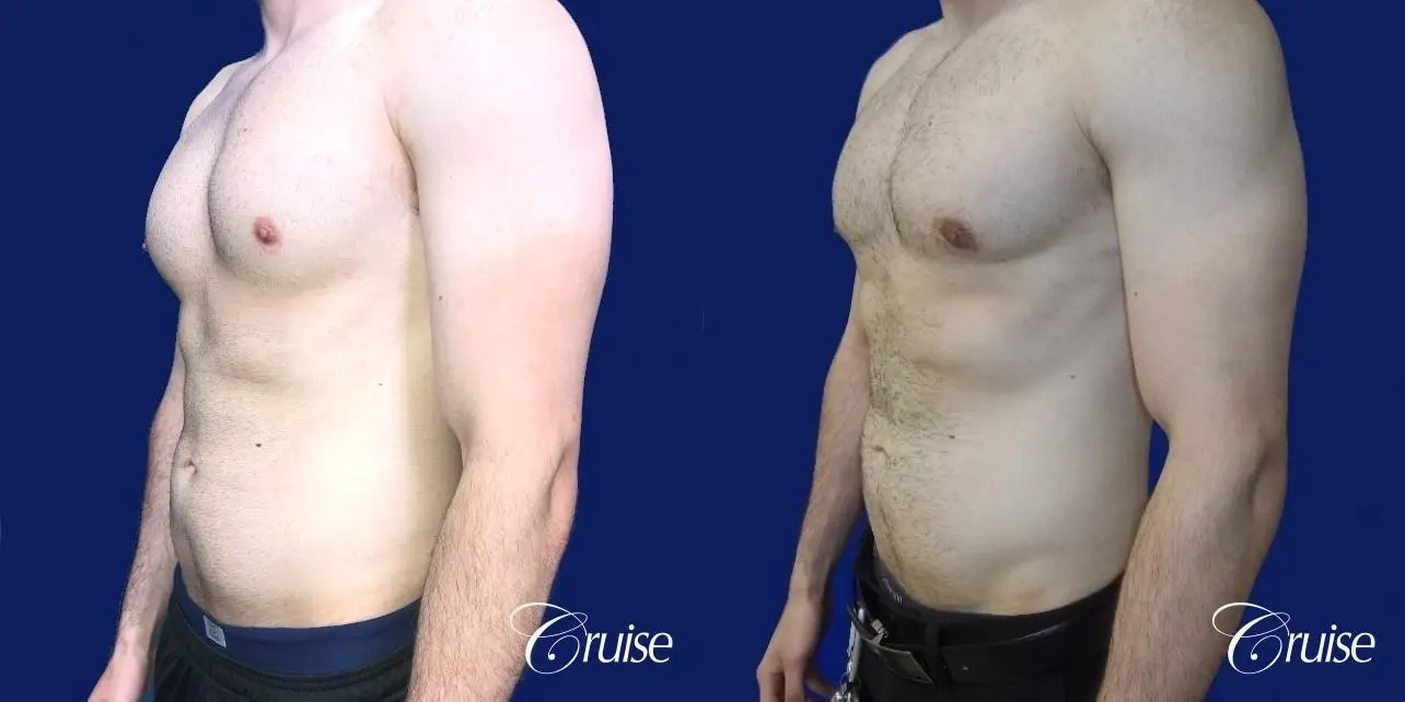 Moderate Gynecomastia -Areola Incision - Before and After 3