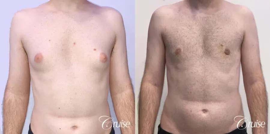Gynecomastia: Patient 132 - Before and After 1